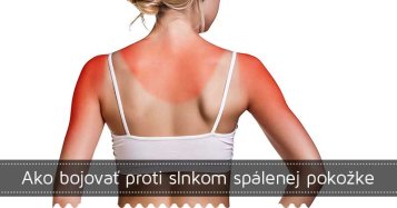 Ako bojovať proti slnkom spálenej pokožke