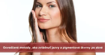 Osvedčené metódy, ako zvládnuť jazvy a pigmentové škvrny po akné