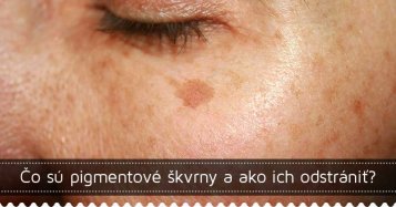 Čo sú pigmentové škvrny a ako ich odstrániť?